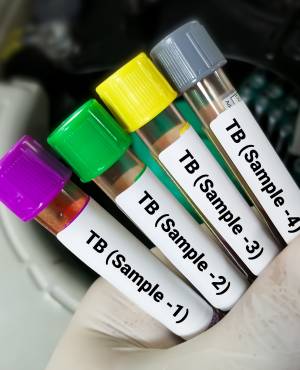 TB Testing Clinic Near Me in El Paso, TX and Horizon City, TX